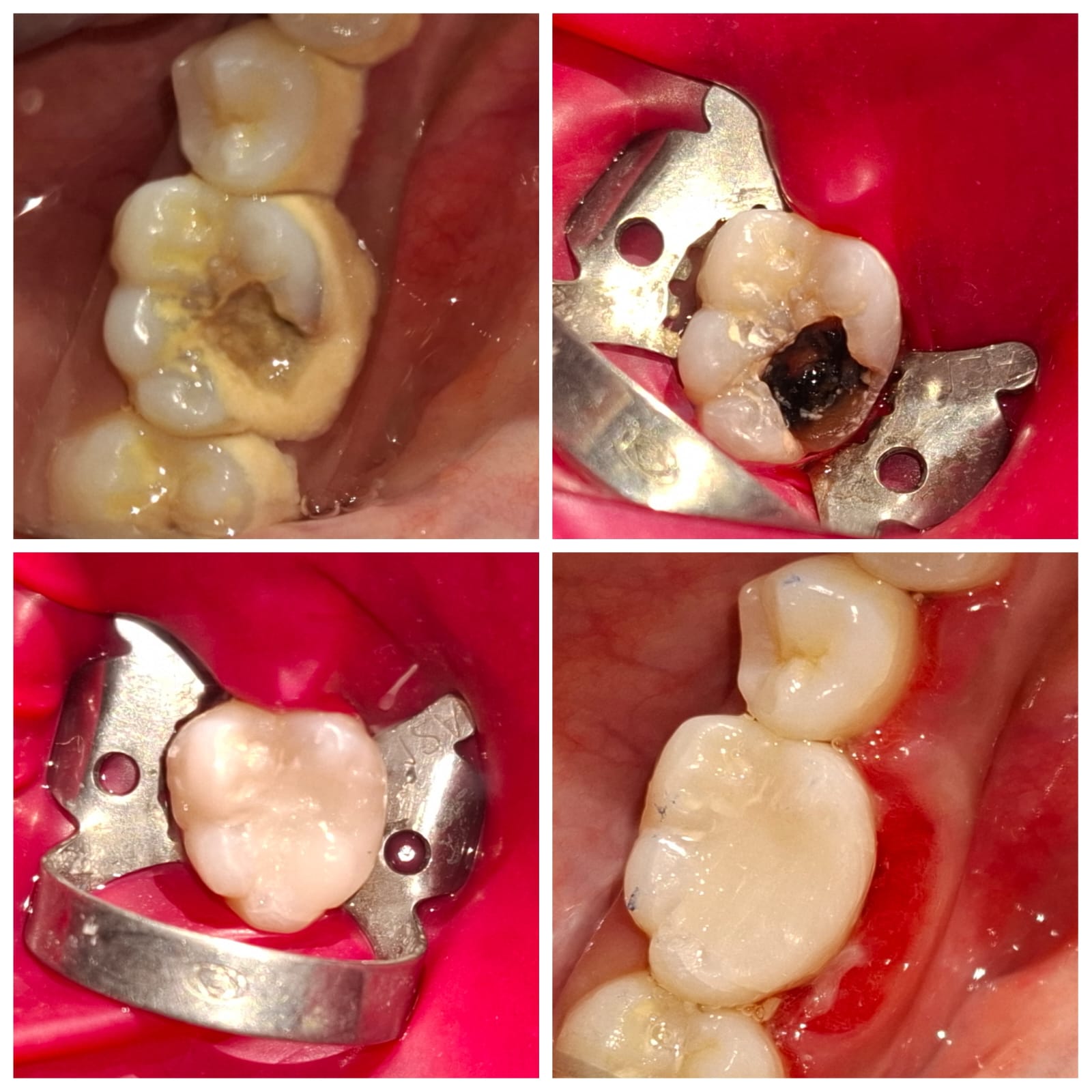 Before and After Smile Transformation Case 3