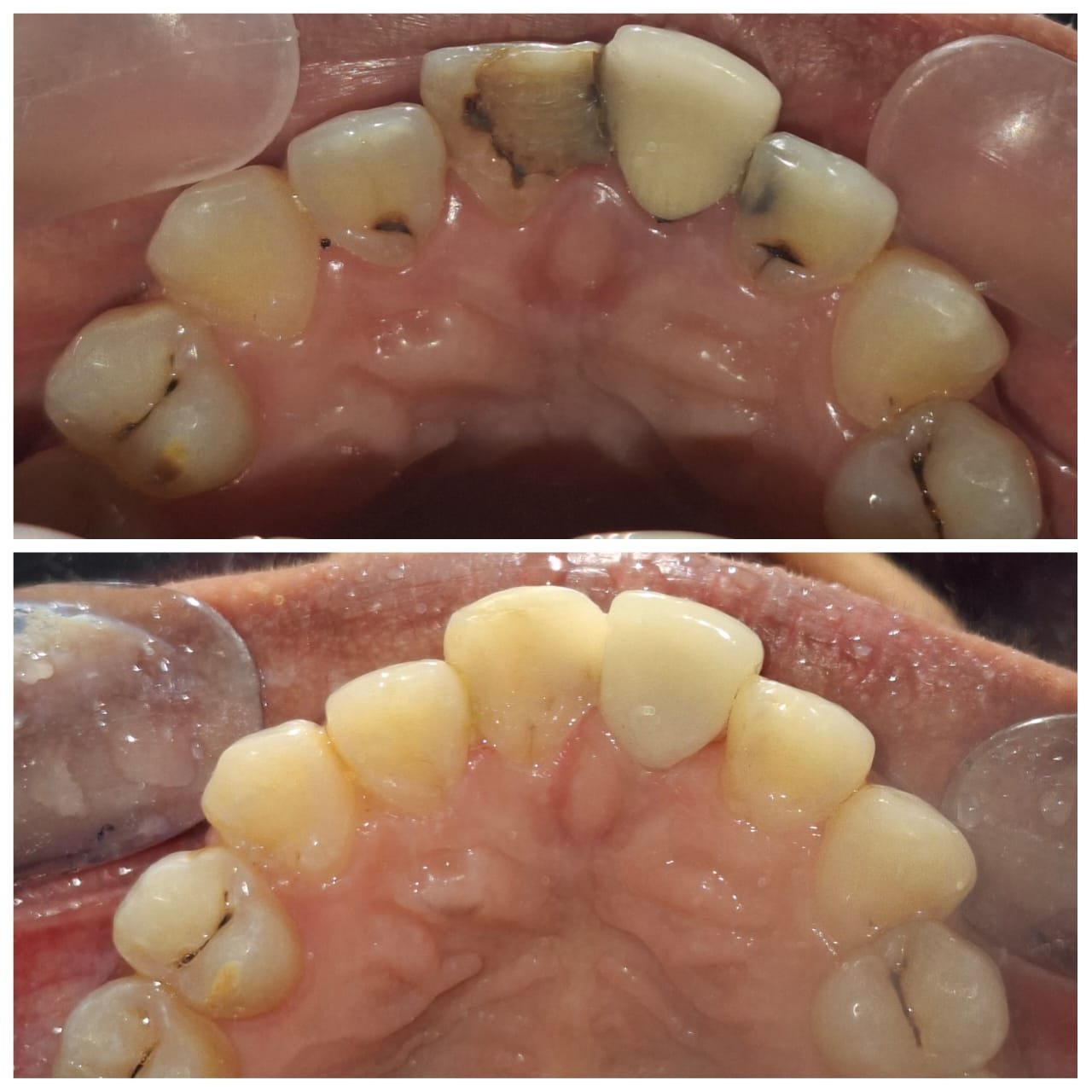 Before and After Smile Transformation Case 4
