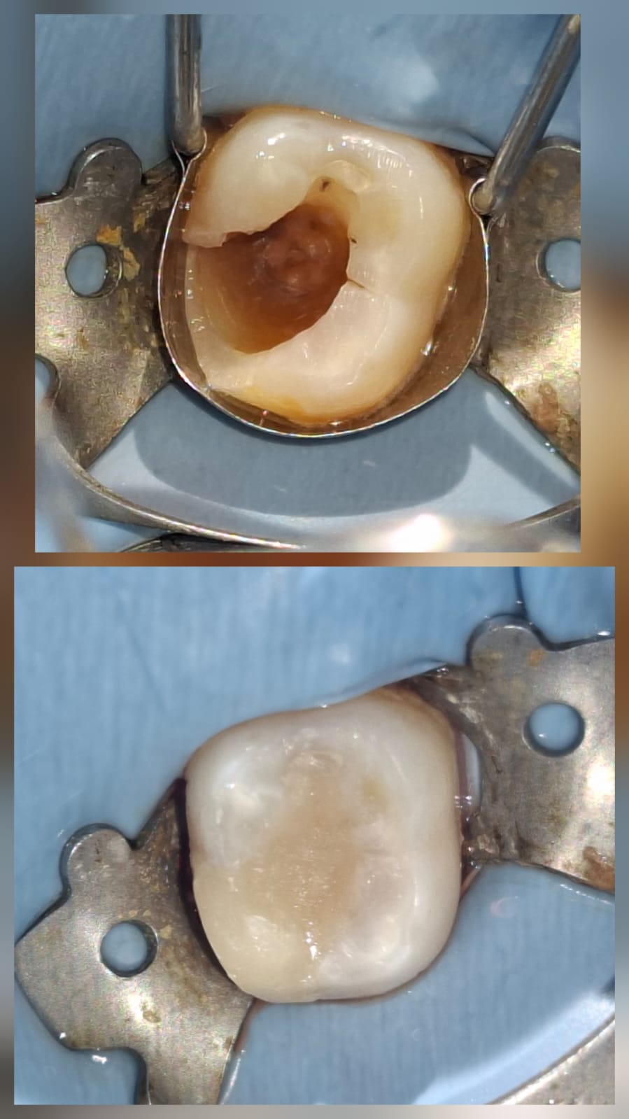 Before and After Smile Transformation Case 5