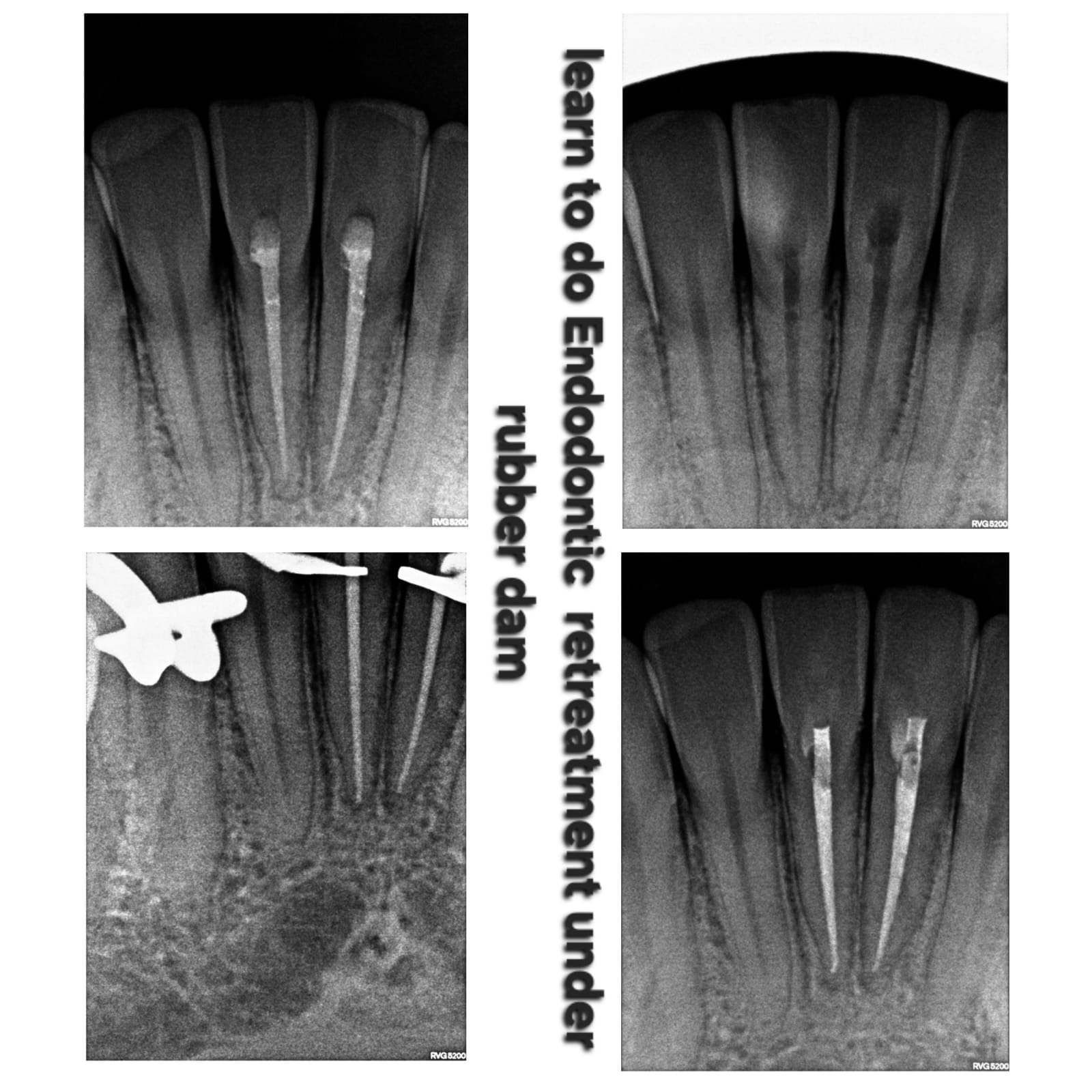 Endodontics Mentorship Case 1