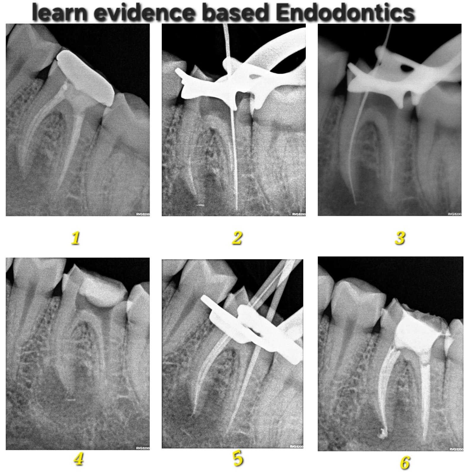 Endodontics Mentorship Case 2