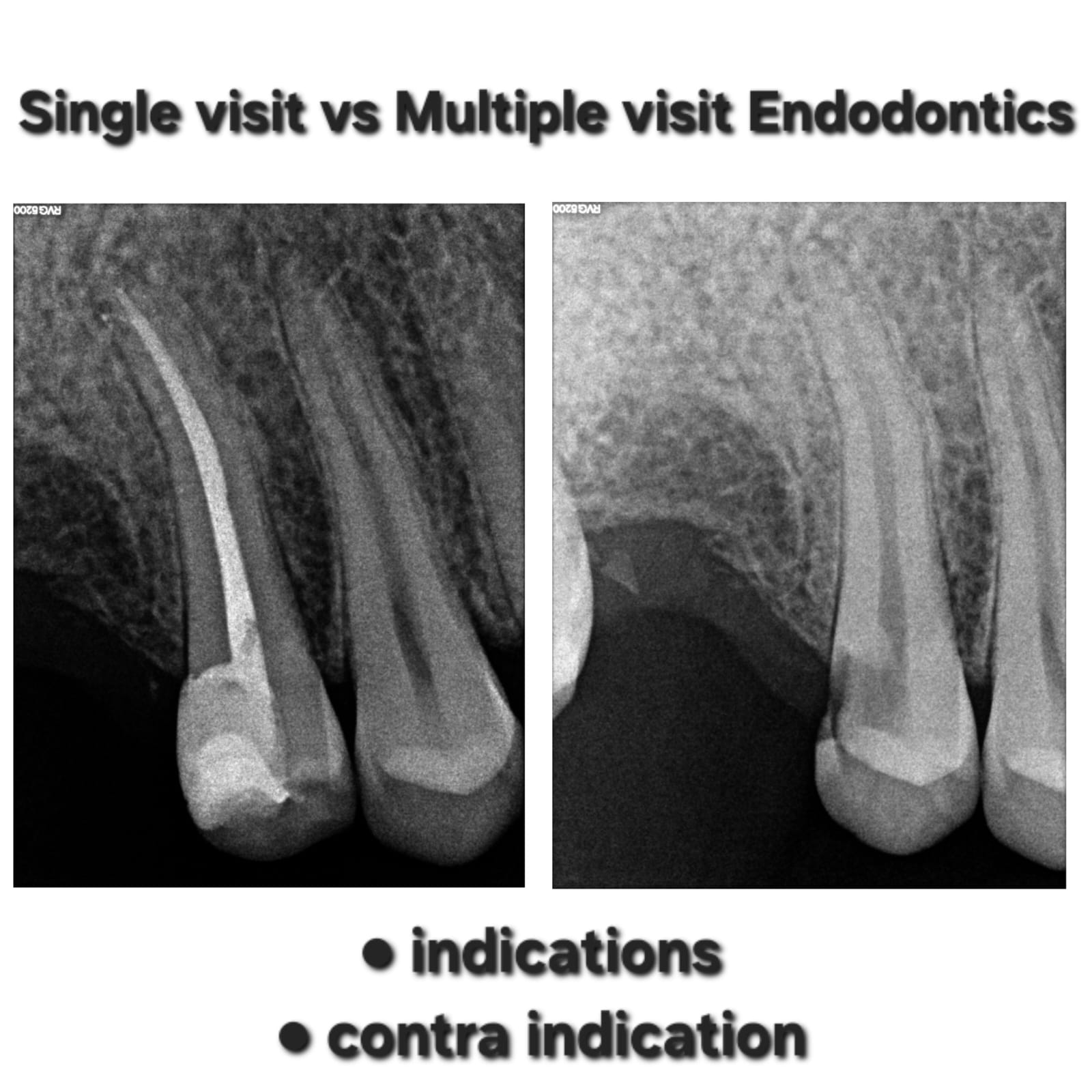 Endodontics Mentorship Case 3